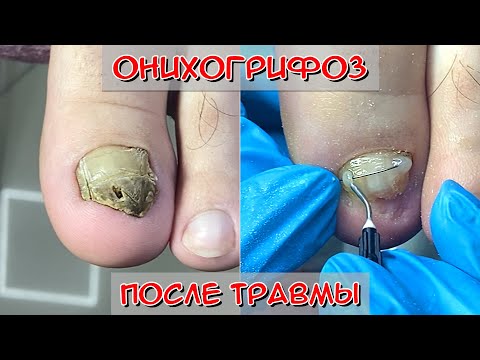 Онихогрифоз после травмы/ Толстый ноготь на большом пальце ноги