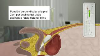 CÓMO SE HACE UNA CISTOSTOMÍA?