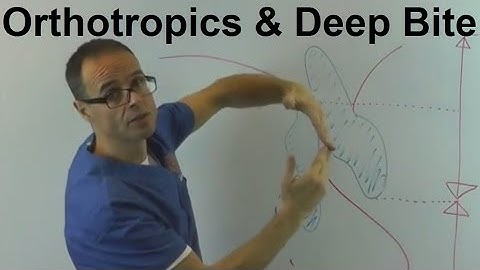 The Effect of Orthotropics on Lower Facial Height on Patients with Deep Bite by Dr Mike Mew