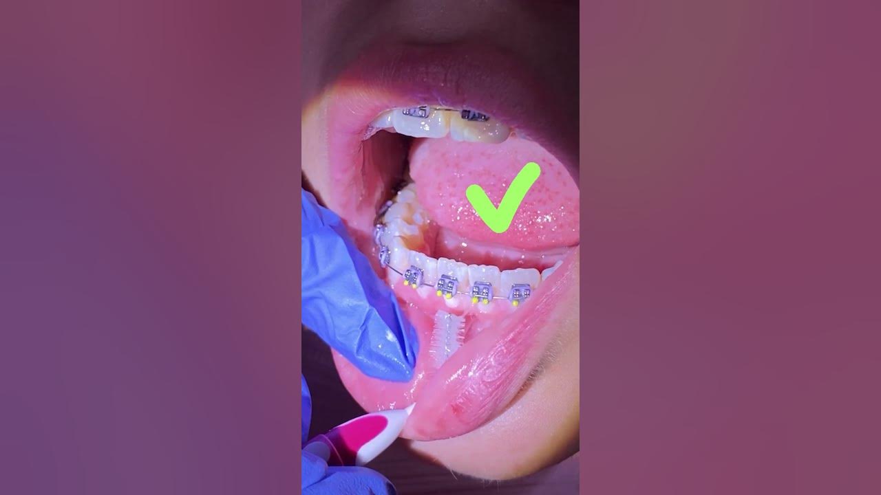 i-got-my-braces-on-now-what-how-can-i-keep-my-teeth-clean-with-braces