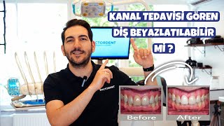 Kanal Tedavili Diş Beyazlar mı?
