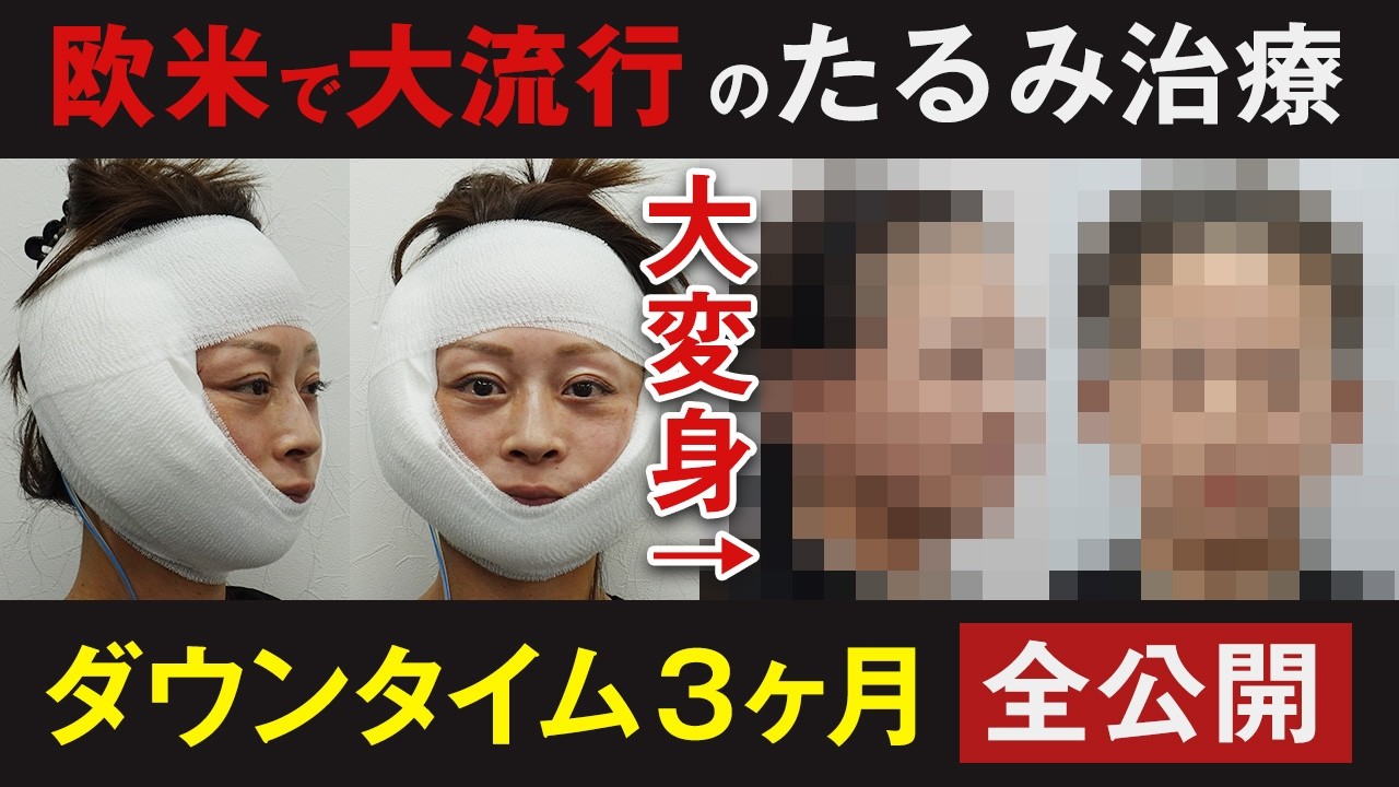 【切開リフト】ガチでつらい？リアルなダウンタイムに完全密着【水の森美容クリニック／MACSリフト・フェイスリフト】