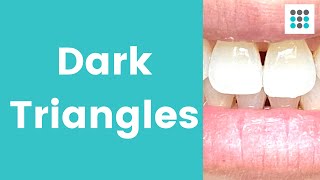 DARK TRIANGLES: what, why, and how to hide them l Dr. Melissa Bailey