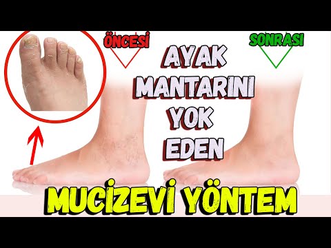 Ayak Mantarına Ne İyi Gelir ? | Ayak Mantarını Yok Eden Mucizevi Yöntem.