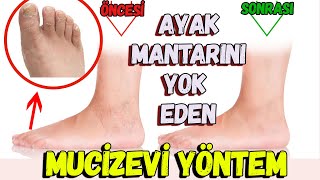 Ayak Mantarına Ne İyi Gelir ? | Ayak Mantarını Yok Eden Mucizevi Yöntem.