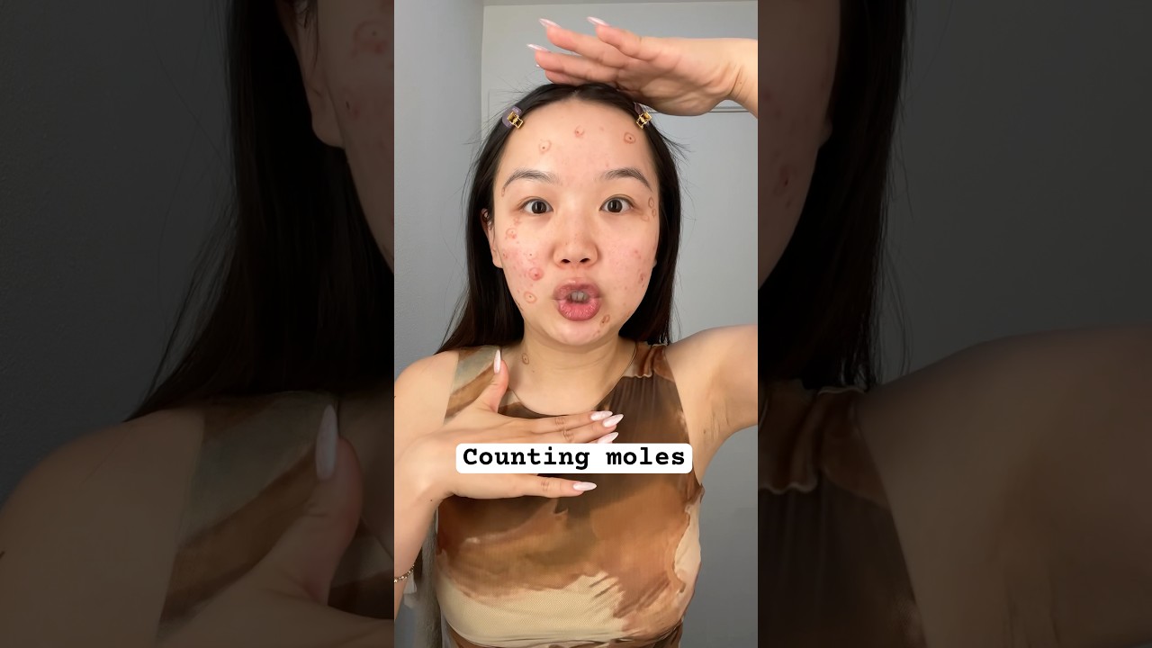 В чём заключается научная основа появления родинок? 🗿 