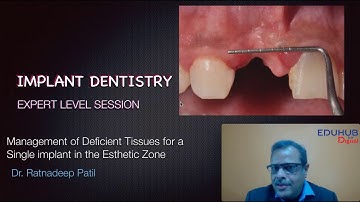 management of deficient tissues for a single implant in esthetic zone