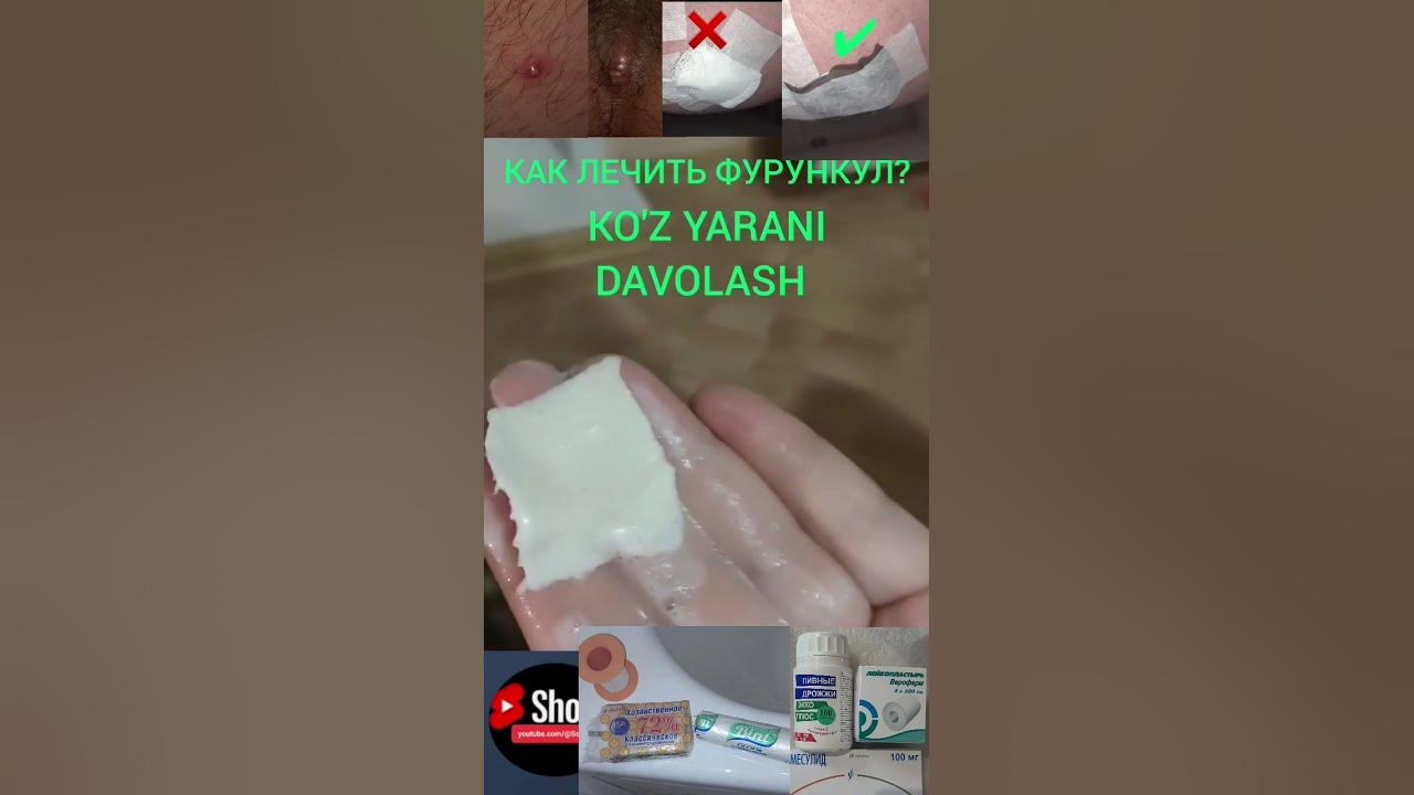 ЧИПКОН ЯНИ КУЗ ЯРАНИ (ФУРУНКУЛ) ДАВОЛАШ- KO'Z YARA YANI CHIPQONNI ...