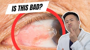 Apa itu Pterigium? Bagaimana Cara Mengobati dan Mencegahnya?