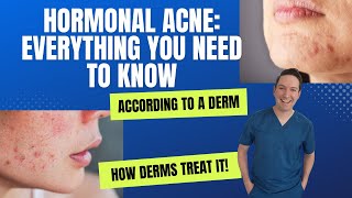 How to tell if you have HORMONAL Acne? #dermatologist #hormonalacne #spironolactone #adultacne