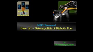 Ultrasound Case 121 - Osteomyelitis Of Diabetic Foot