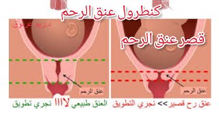 كنطرول عنق الرحم. الحمدلله على كل حال