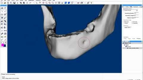 Remove Internal Structures of Lower Jawbone