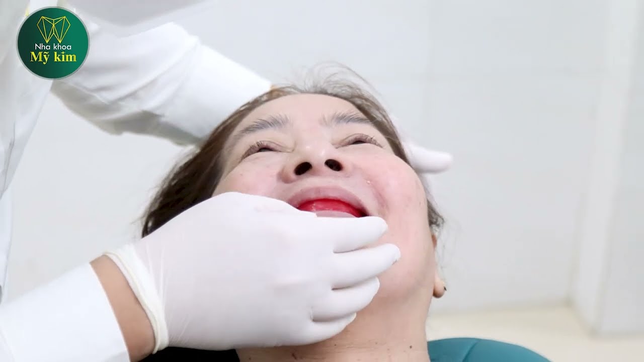 Quy trình phục hình hàm tháo lắp | Nha khoa Mỹ Kim