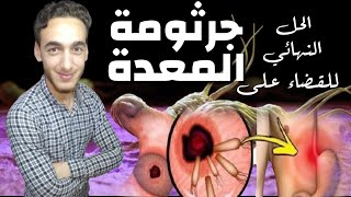 الحل النهائي للقضاء تماما على جرثومة المعدة بأبسط الطرق. الميكروب الحلزوني | Helicobacter Pylori