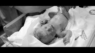 Parto Cesárea Nascimento Helena - Hospital Policlínica