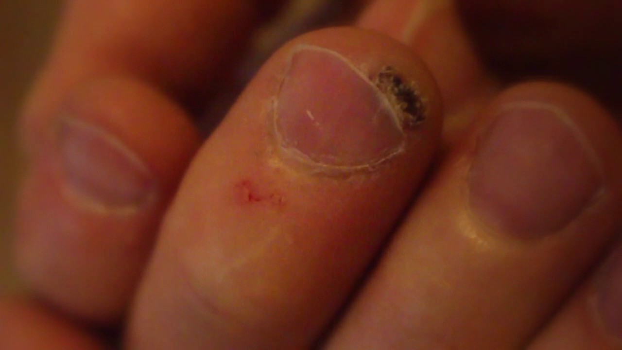 Gross Wart Under Fingernail Youtube