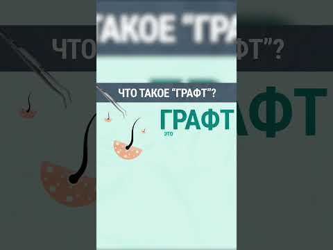 Пересадка волос - что такое «графт» ?🤔👨🏻‍⚕️