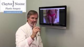 What makes a good drainless tummy tuck candidate? | Dr. Claytor answers REALSELF questions