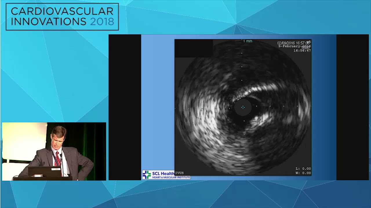 CVI2018 Session: How I managed a difficult Lotus case - Will Anderson, MD interventional cardiology jobs