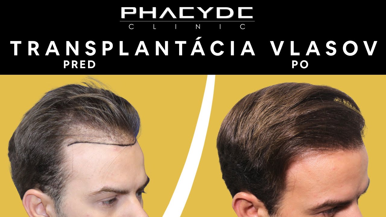 Transplantácie vlasov metódy - PHAEYDE Clinic⚡