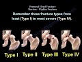 Femoral Head Fracture Review, Pipken Fracture - Everything You Need To Know - Dr. Nabil Ebraheim