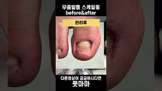 발톱스케일링 관리 전후 보고가실게요 #무좀발톱 #fungustoenail #athlete #발톱무좀 #발톱관리 #레푸스 #풋마마 #shorts
