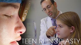 Teen Rhinoplasty: Before & After One Year