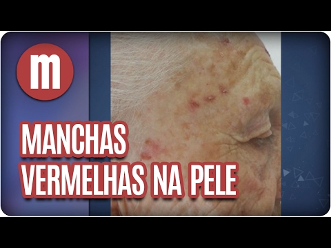 Vídeo: Manchas Vermelhas Na Pele: Causas, Tratamentos E Muito Mais