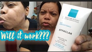 CLEAR SKIN IN 14 DAYS La Roche-Posay REVIEW