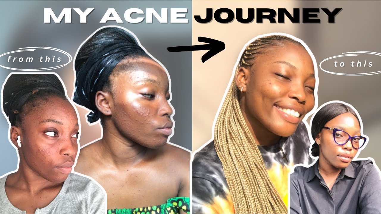 HOW I CLEARED MY ACNE IN LESS THAN A MONTH | MY ACNE JOURNEY | MANDIE A ...