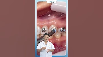 Quy Trình Gắn Mắc Cài Niềng Răng  | Bác Sĩ Yên
