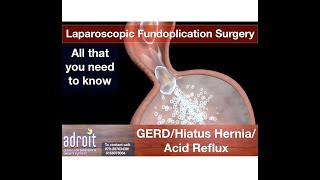 Acid Reflux (GERD, Hiatus hernia, heartburn, and acidity) treatment and laparoscopic surgery