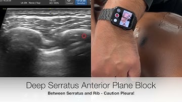 Serratus Anterior Plane Block - Updated