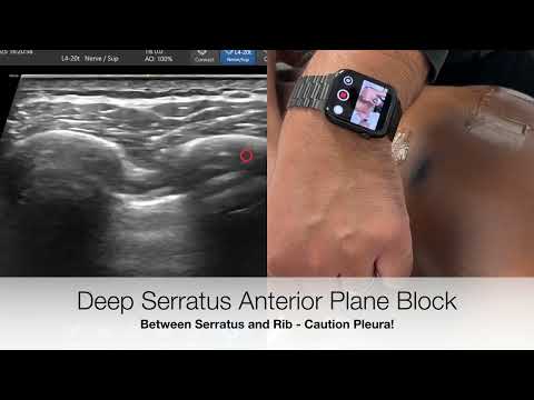 Image of Serratus Anterior Plane Block - Updated