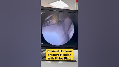 Proximal Humerus Fracture Fixation With Philos Plate #fracture #shoulderpain #drsaichandra
