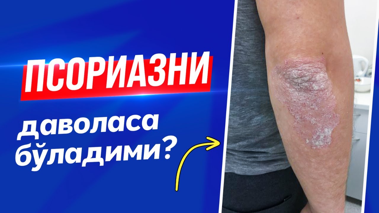 Psoriazni Davolasa Bo'ladimi - Murojaat uchun: +998 90 788 83 13