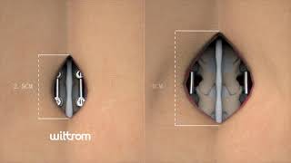CBT - Cortical Bone Trajectory for Midline and Percutaneous Procedures