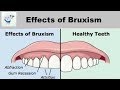 Effects of Teeth Grinding | Bruxism Effects of Teeth Grinding | Bruxism
