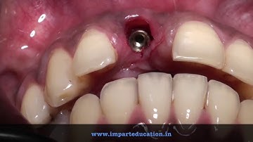 Socket Shield Technique with Provisional Crown