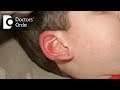 What can be done for Swollen Ear caused by concentrated antiseptic? - Dr. Sriram Nathan