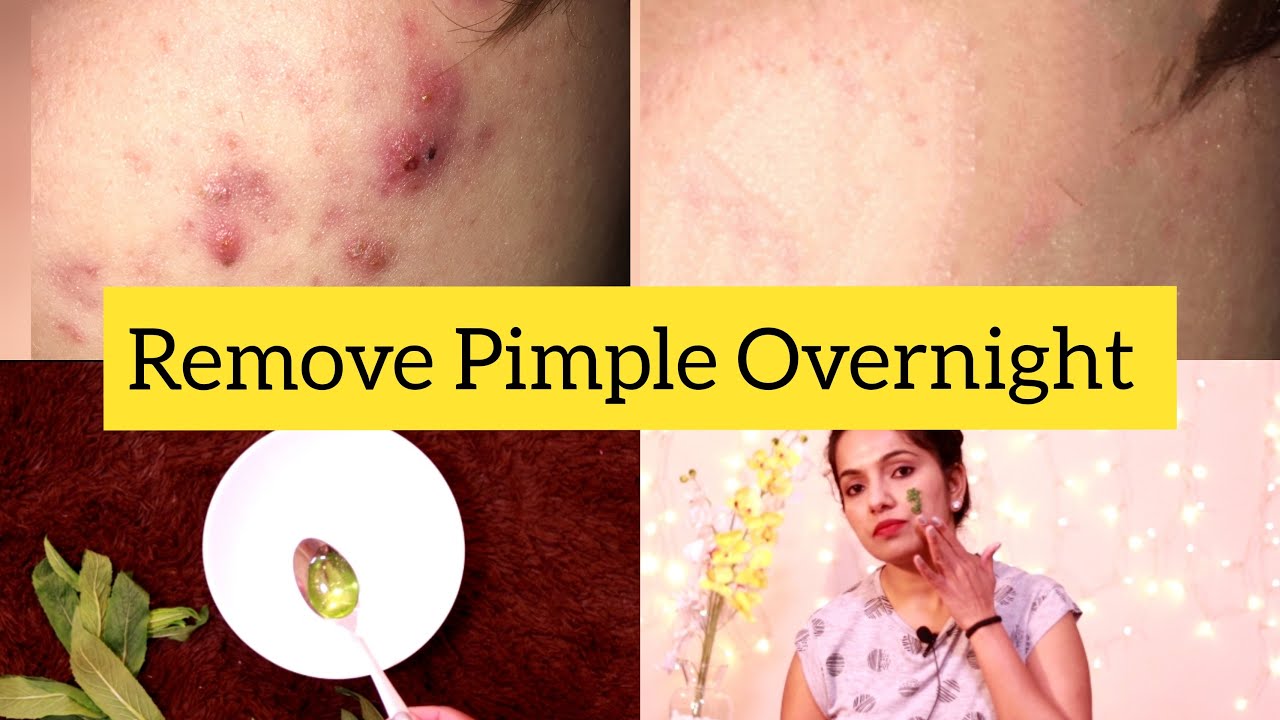 pimples marks on face removal tips in kannada