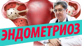 видео Аденомиоз матки: причины, признаки, лечение и диагностика