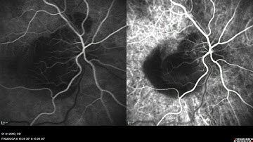 SPECTRALIS FA ICGA Simultan
