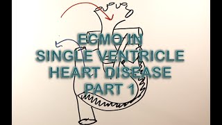 Ecmo Cannulation In Chd-Interstage