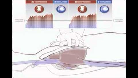 AHA 2010 Vid2 Coronary Perfusion Pressure