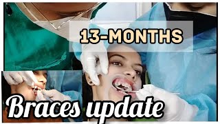 13-months braces update/braces tightening vlogyoutubehowtobracesdentalteeth