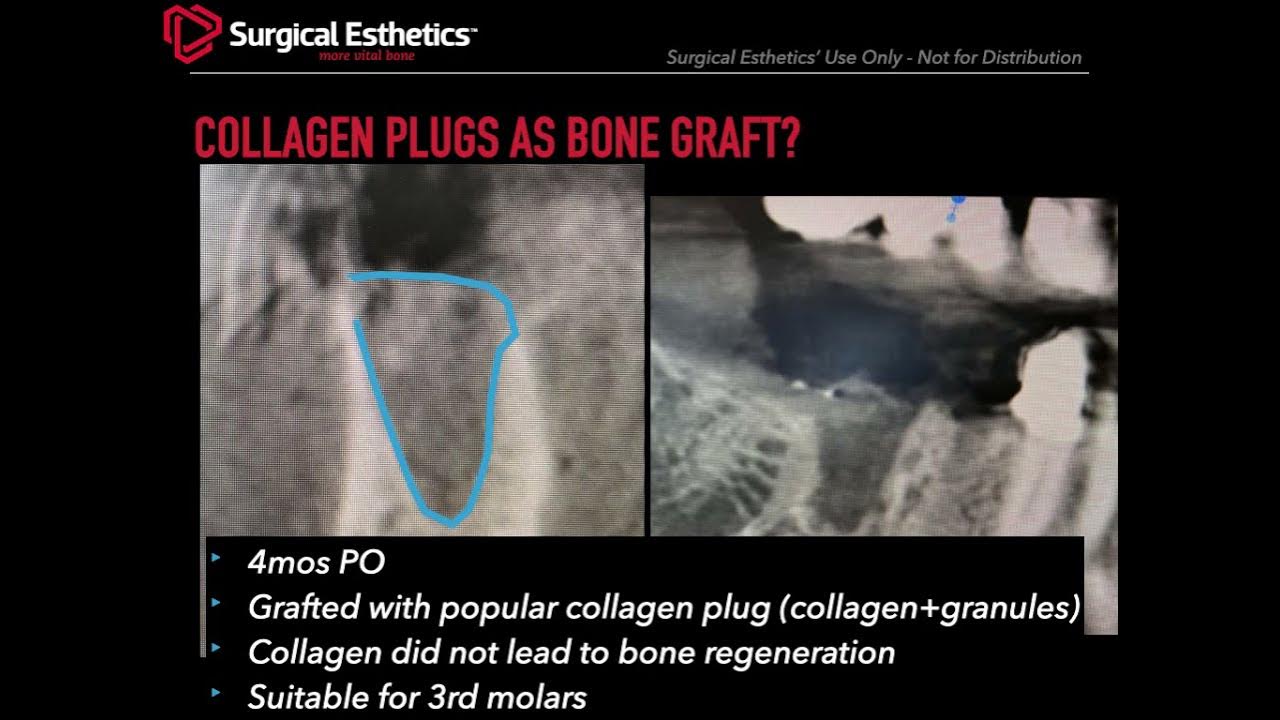 Collagen Plugs as Bone Graft? YouTube