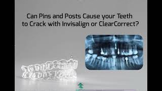Pins and Posts and Severe Abfractions with Invisalign and ClearCorrect