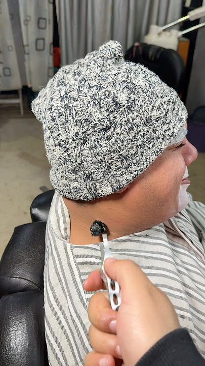 ازاله الحبايه المسرطنه😱😱😱